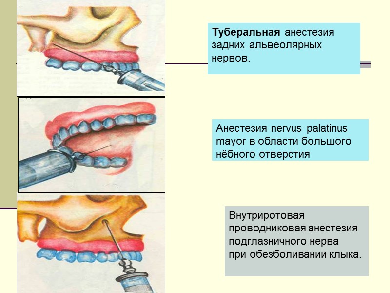 Внутриротовая проводниковая анестезия подглазничного нерва   при обезболивании клыка. Туберальная анестезия  